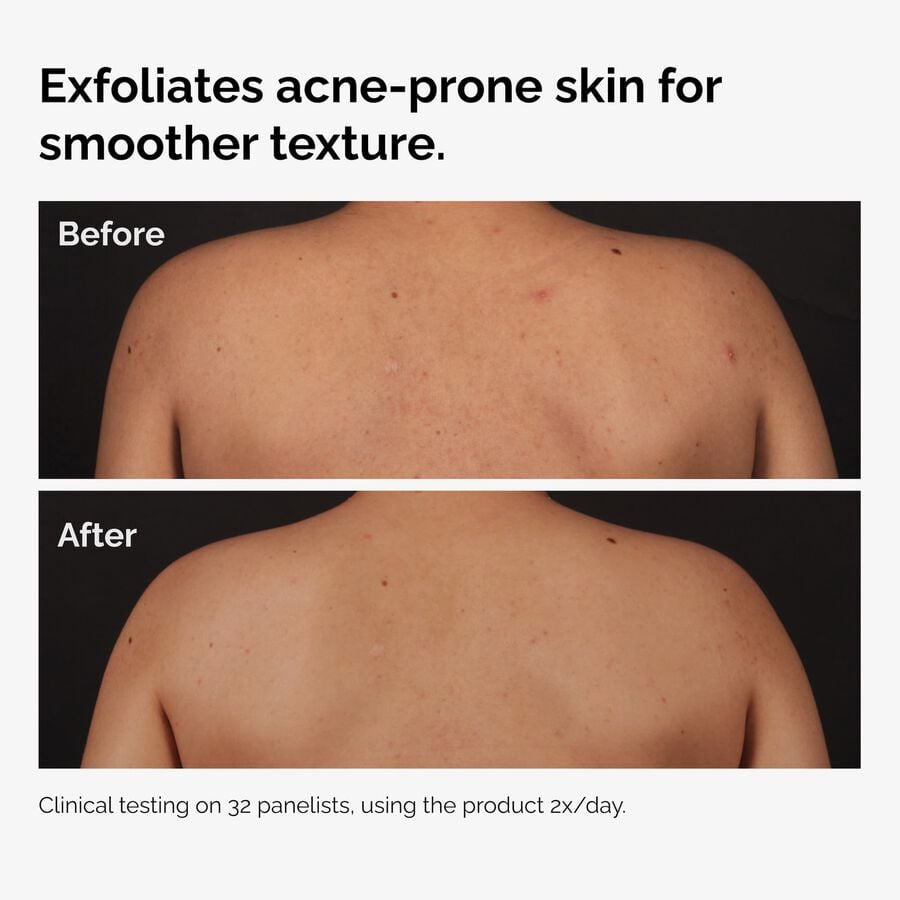 the-body-care-collection-p2 ord-salicylic-acid-body-serum-before-after-graphic-NA.jpg
