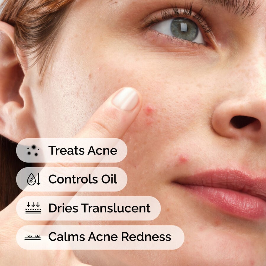 sulfur-10-powder-to-cream-concentrate-i9 ord-sulfur-10pct-powder-to-cream-concentrate-model-application-with-benefits-acne.jpg