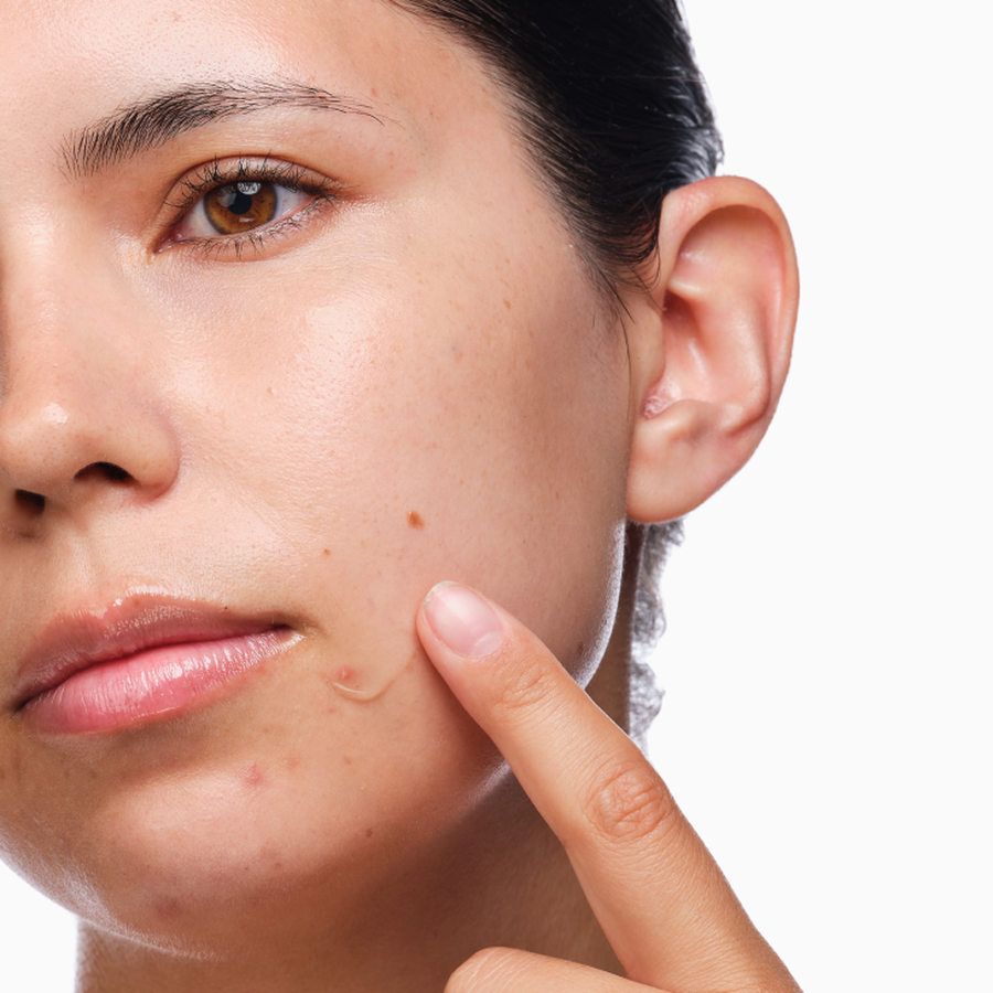 the-acne-set-x1 rdn-the-acne-set-application.png
